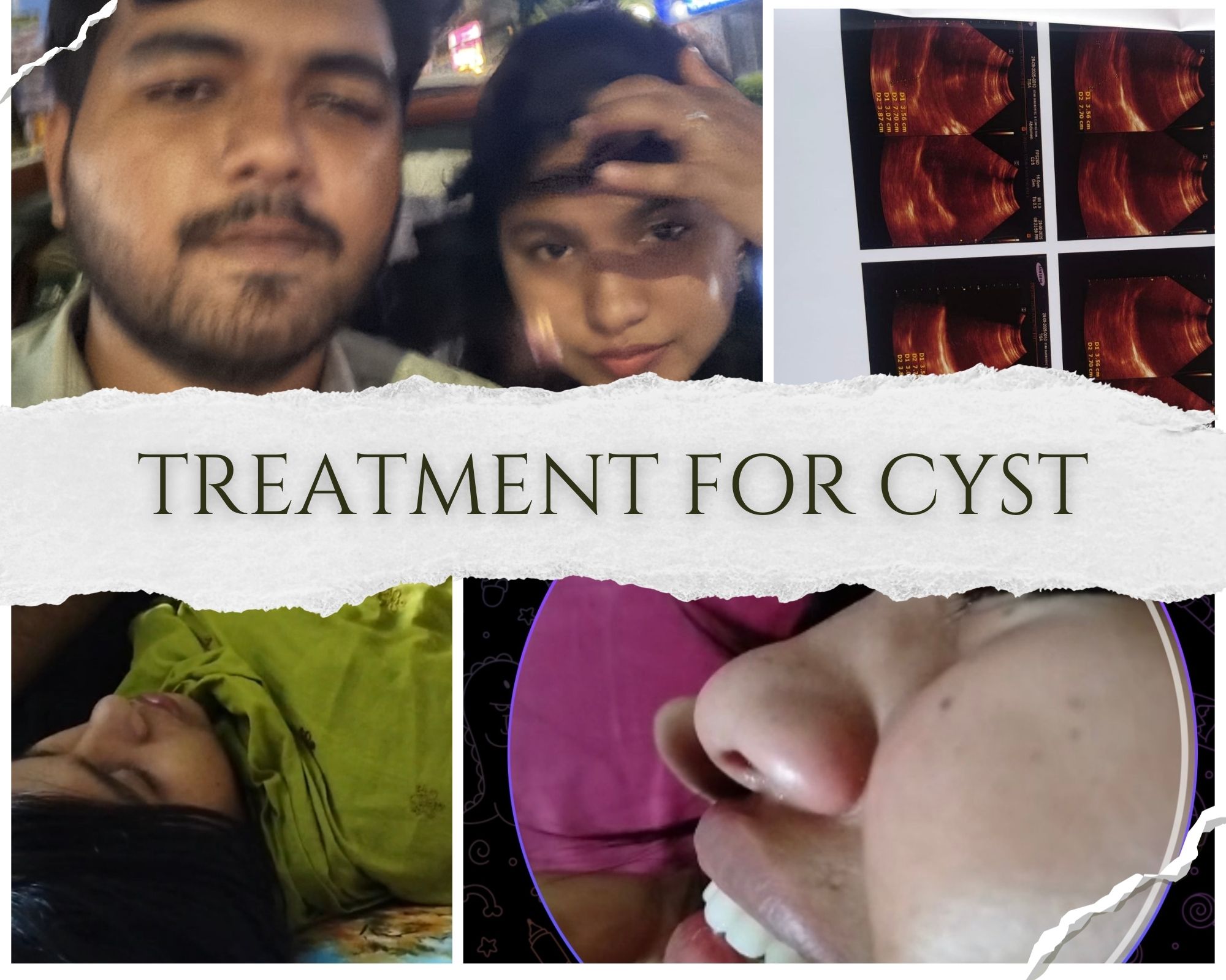 Surgery for my wife's cyst disease